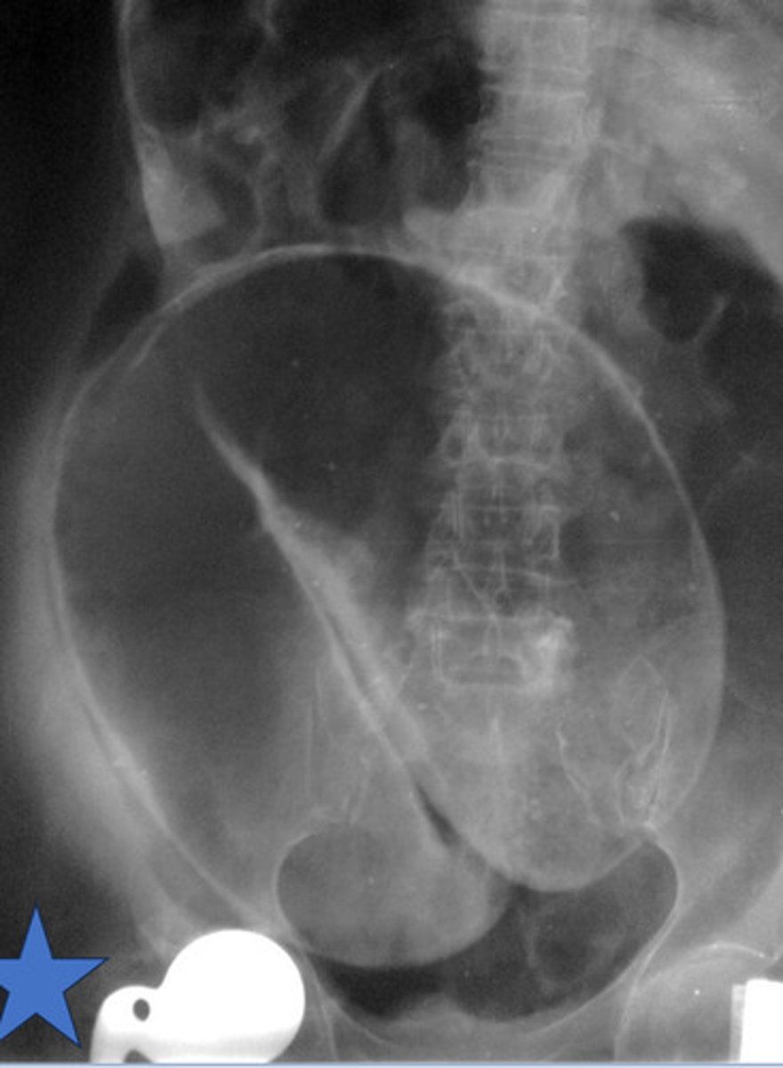 <p>sigmoid volvulus: twisted sigmoid colon</p>