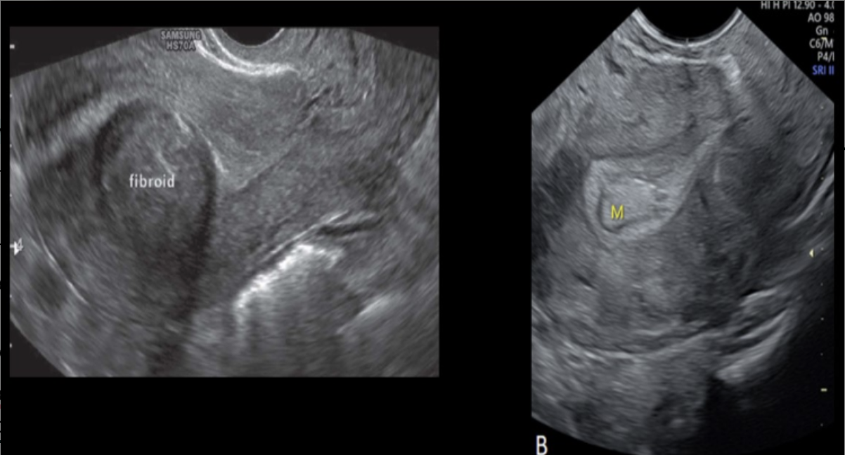 <p>which is true about differentiation of <strong>submucosal fibroid</strong> from an <strong>endometrial polyp</strong></p><p><strong>.</strong></p><p>a) fibroids always form within the tissue while polyps always form a thin stalk</p><p>b) fibroids are normally more hypoechoic while polyps tend to be more hyperechoic</p><p>c) multiple fibroids usually form while polyps usually are solitary in formation</p><p>d) hysterosalpingography can be used to effectively differentiate a fibroid from a polyp in nearly all pts</p>