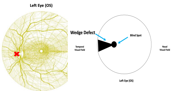 <p>Damage to the <strong>superior</strong>, <strong>inferior </strong>and <strong>papillomacular </strong>nerve fiber bundles causes a field defect <strong>corresponding </strong>to the location and configuration of the affected nerve fiber layer. </p><p>These defects respect the<strong> horizontal midline </strong></p><p>If the<strong> nasal radial bundle </strong>is affected, a <strong>wedge shape defect </strong>emanates <strong>from the blind spot.</strong></p>