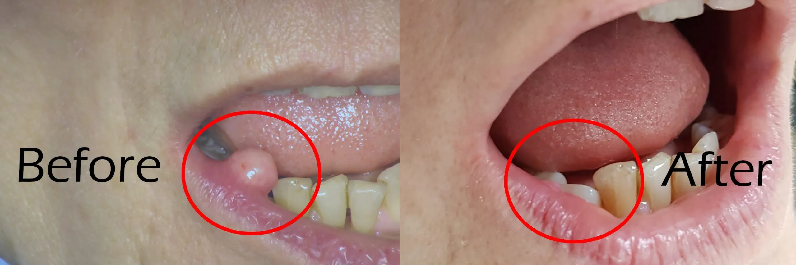 <p>fibroma</p>