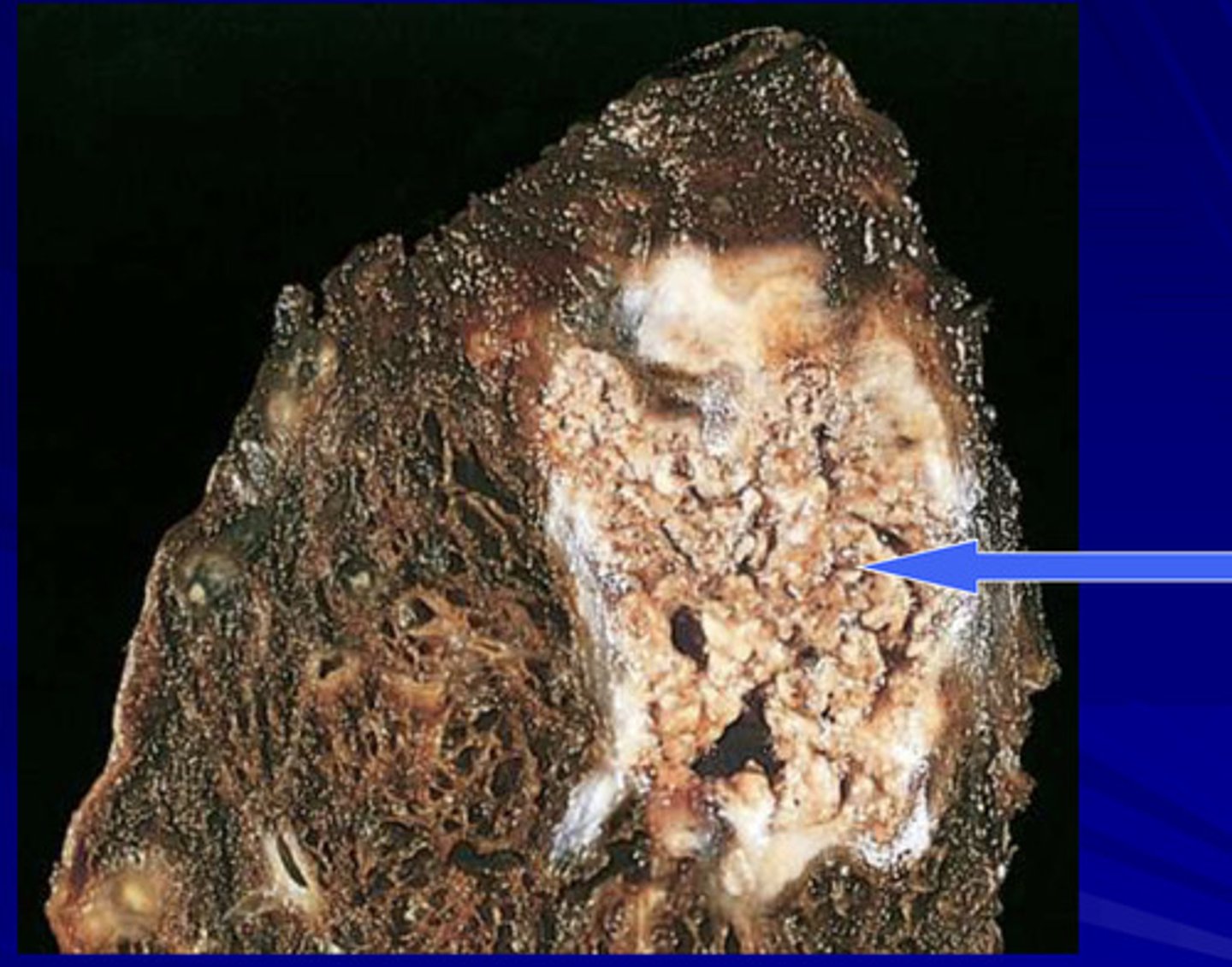 <p>a variant of coagulation necrosis in which dead tissue has a firm, dry, cheesy texture (dead tissue looks like cottage cheese)</p>