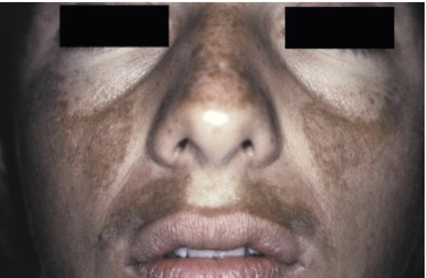 <p><span><span>which type of </span></span>metabolic/systemic melanin-associated pigmented lesions?</p><ul><li><p><span><span>brown or gray-brown patches of hyperpigmentation on the face (sometimes a mylar pattern)</span></span></p></li><li><p>aka mask of pregnancy = chloasma&nbsp;&nbsp;</p></li></ul><p></p>