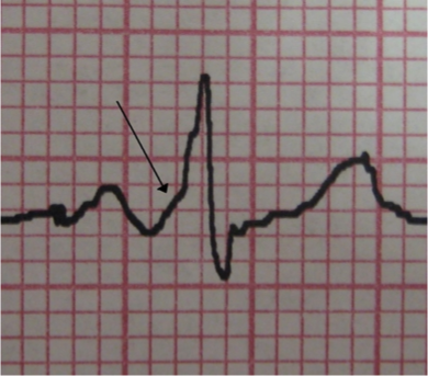 <p>What does this refer to</p><ul><li><p>12-lead showing WPW pattern</p><ul><li><p>W – wave (delta) (arrow on image)</p></li><li><p>P - PR interval (&lt;0.12 seconds) short</p></li><li><p>W – wide QRS</p></li></ul></li></ul><p></p>