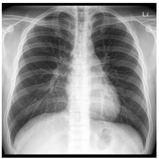 <p>is there anything wrong w this pts diaphragm </p>