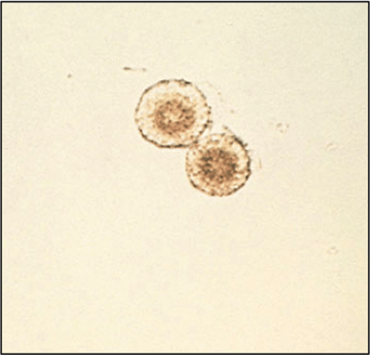 <p>- yellow/brown spheres w. radial striations<br>- seen with tyrosine crystals<br>- acidic</p>