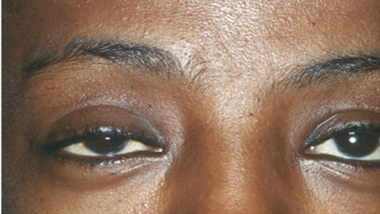 <p>Drooping upper lid</p>