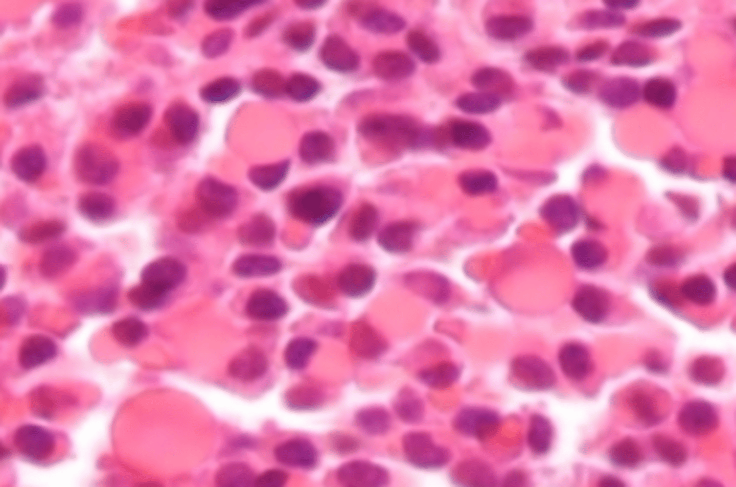 <p>Plasma cell component</p><p>Pinkish or eosinophilic cytoplasmic globules which represent produced immunoglobulins</p>