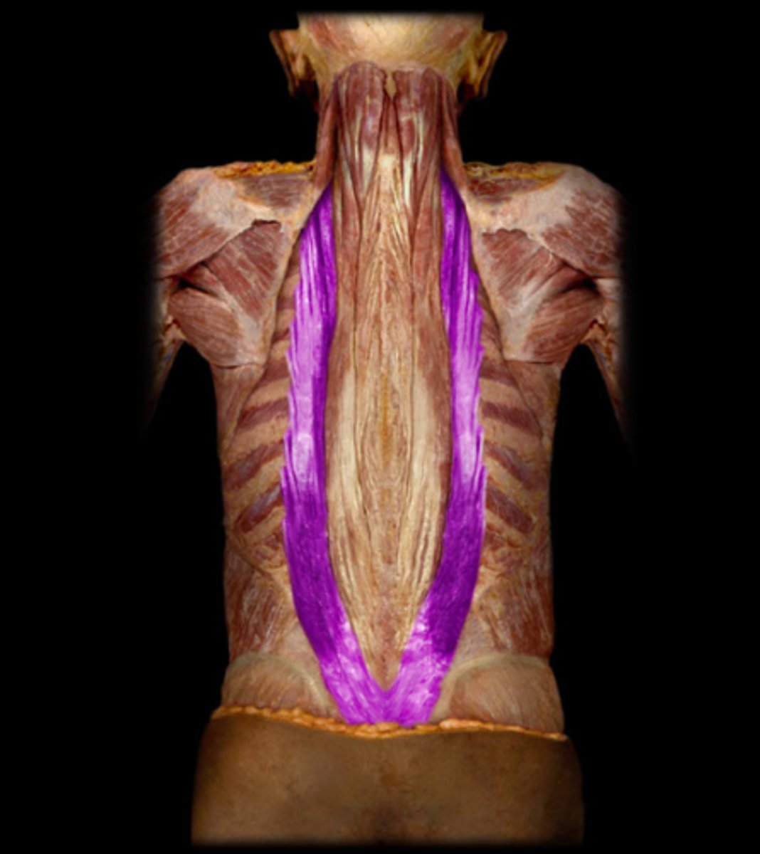 <p>composed of:</p><p>iliocostalis lumborum M</p><p>iliocostalis thoracis M</p><p>iliocostalis cervicis M</p>
