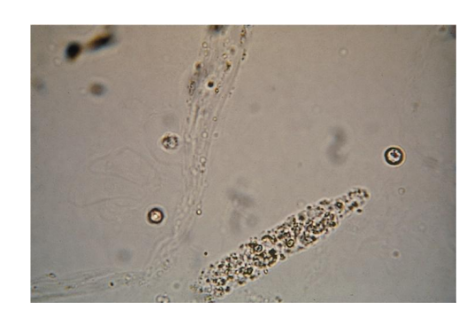 <p><span>Coarse and finely</span></p><p><span>granular</span></p><p></p><p><span>Granule origin</span></p><p></p><p><span>RTE lysosomes, excreted in</span></p><p><span>normal metabolism, more</span></p><p><span>after exercise and activity</span></p><p></p><p><span>Disease states:</span></p><p><span>Disintegration of cellular</span></p><p><span>casts and tubule cells or</span></p><p><span>protein aggregates filtered</span></p><p><span>by the glomerulus</span></p>