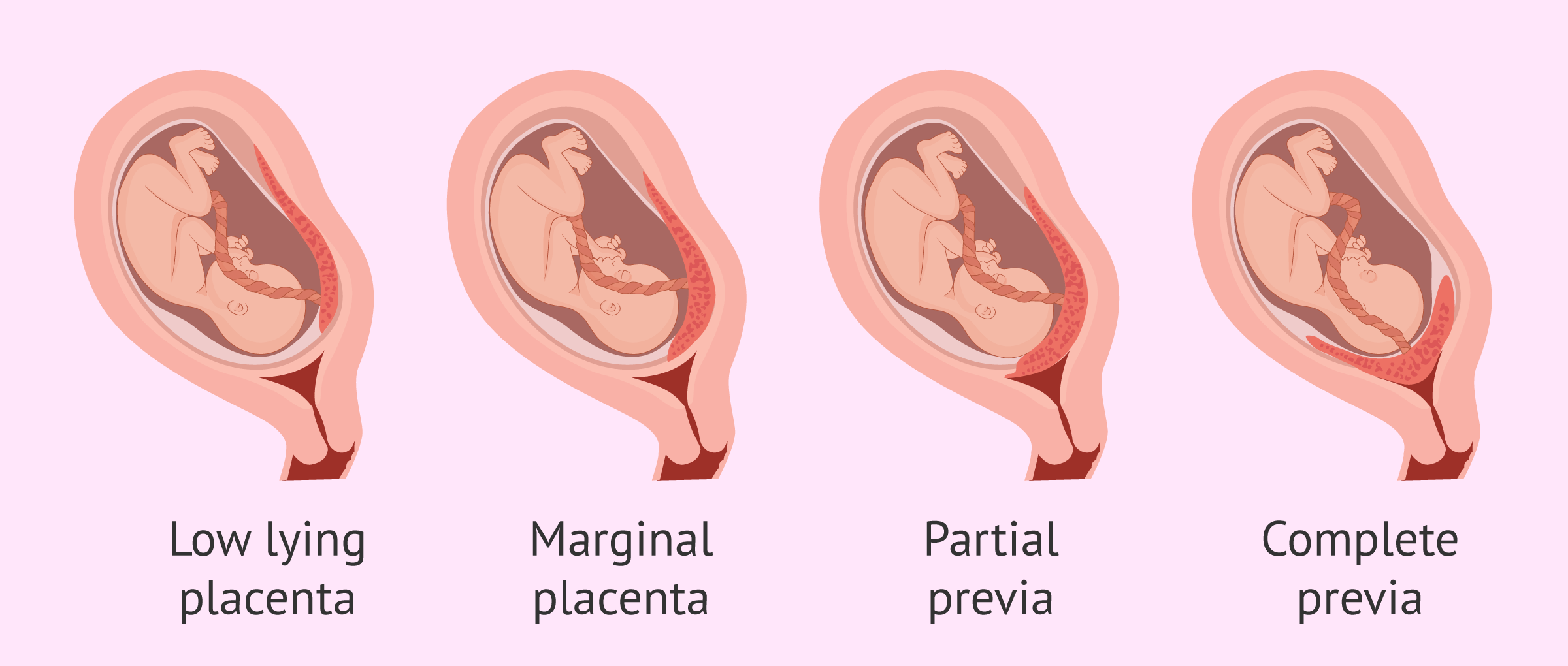 <p>The placenta partially covers your cervix.</p>