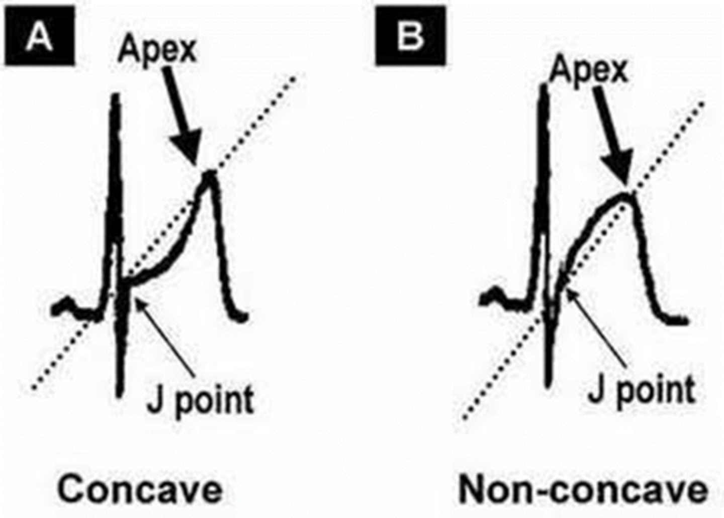 <p>- ST elevation in any shape can indicate STEMI</p><p>- horizontal vs. convex</p>