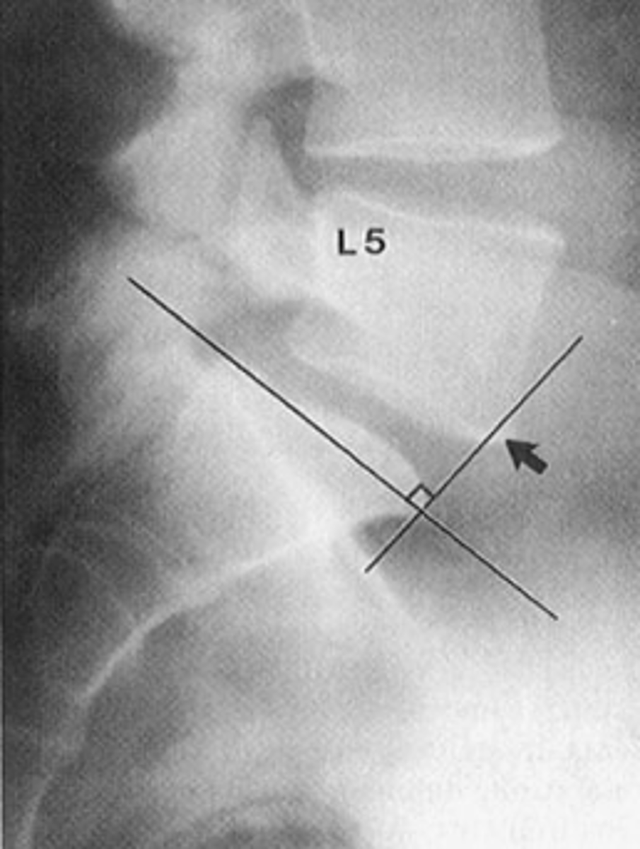 <p>ID spondylolisthesis measurement</p>
