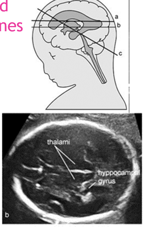 <p>landmarks:</p><ul><li><p>thalami</p></li><li><p>hippocampal gyrus</p></li></ul>