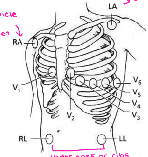 <p><strong>Mason-Likar Limb Leads</strong></p><p>-Use this if the patient is moving around or doing a ______ test</p><p>-The right arm lead should be placed off the _______, below the clavicle</p><p>-The left arm lead should be placed off the deltoid, below the ________</p><p>-The right leg and left leg leads should either be placed below the ___ of the ribs on their respective sides or on the _____ if the patient has abdominal fat</p>