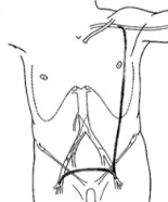 <p>axillary artery to distal EIA or CFA</p><p>bypass severe AO disease</p>