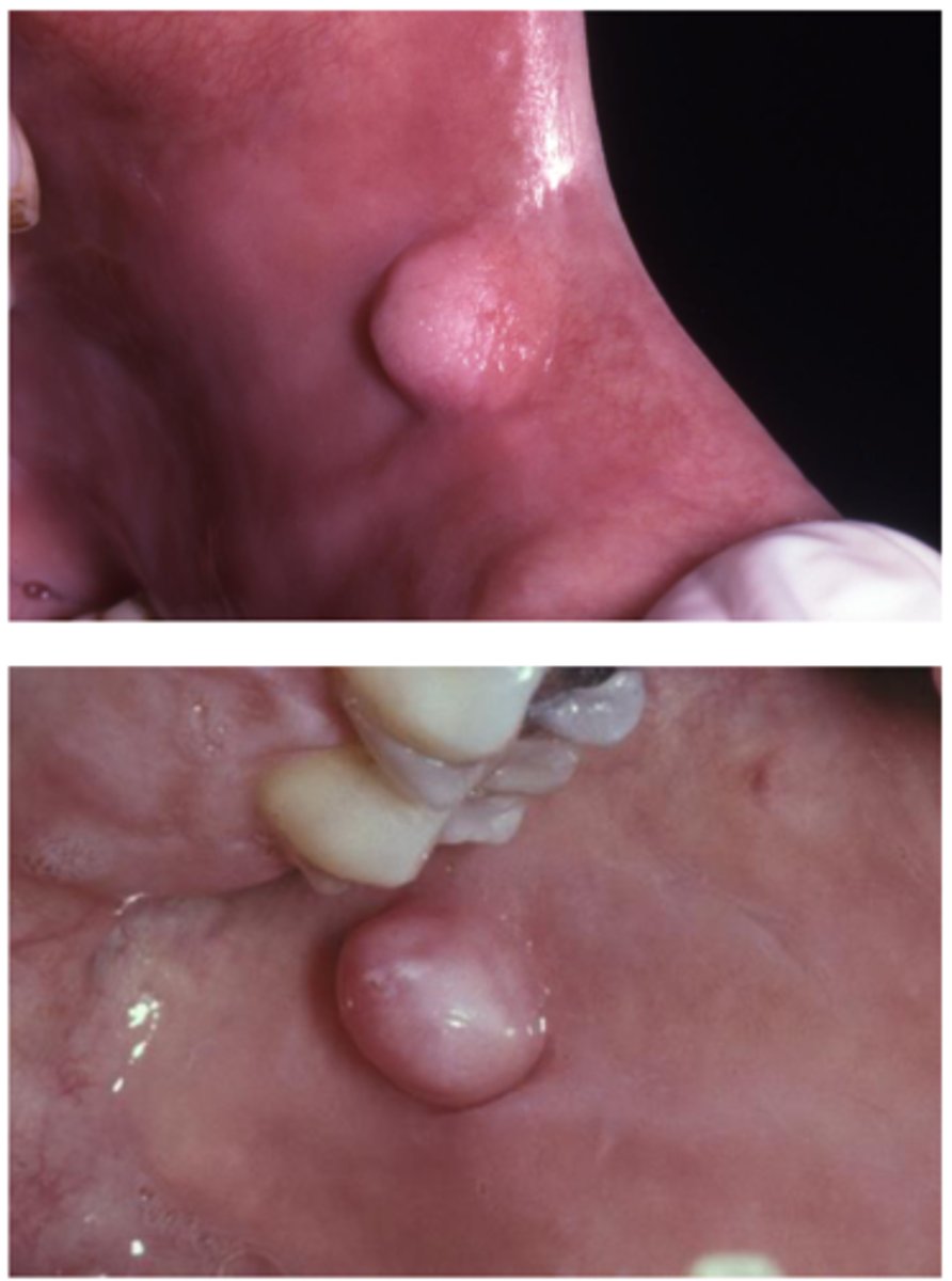 <p>• Most common benign soft</p><p>tissue mass</p><p>• Results from irritation or trauma</p><p>• Reactive lesion</p>