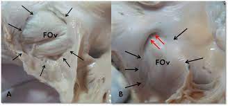 * internal Aspect of POSTERIOR wall
* recieves SVC (no valve) + IVC (redumintery valve)

  \+ Coronary Sinus (Developed Valve)
* Has 
  * Fossa Ovalis + its Limbus in the septal Wall 