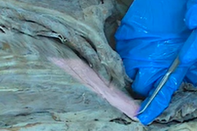 <p>A muscle that originates on the spinous process of upper thoracic vertebrae, inserts on the upper ribs, and functions to elevate the ribs.</p>