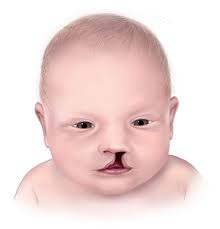 <p>Wolf-Hirschhorn Syndrome is caused by a ______ in the terminal end of chromosome _. The displayed phenotypes are microcephaly, cleft lip, and possible cleft palate</p>