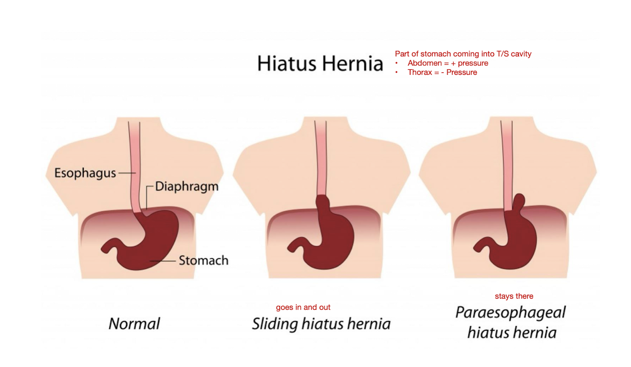 <p>Esophageal Pain: Hiatal Hernia</p><ul><li><p>3 Common S/S:</p></li><li><p>Common location of pain:</p></li></ul><p></p><p></p>