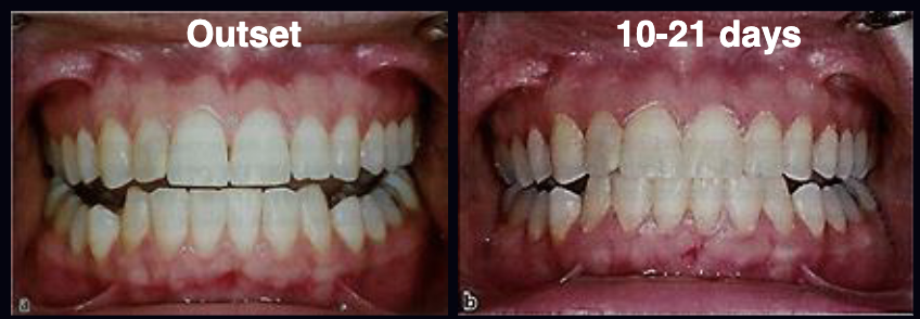 <p><span>A classic study by Harold Löe et al. (1965) involved the withdrawal of oral hygiene measures in 12 healthy students resulting in plaque accumulation and clinically evident gingivitis after 10-21 days. What is the takehome message? What kinds of bacteria were isolated at the outset vs after 10-21 days?</span></p>