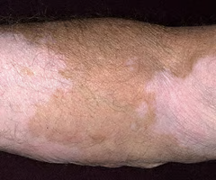 <p>a macule greater than _cm in diameter</p>