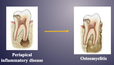 <p>pericapical inflammatory disease → osteomyelitis </p>