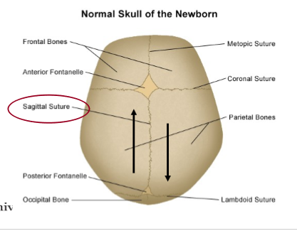 <ol><li><p>premature fusion of the saggital suture </p></li></ol><p></p>