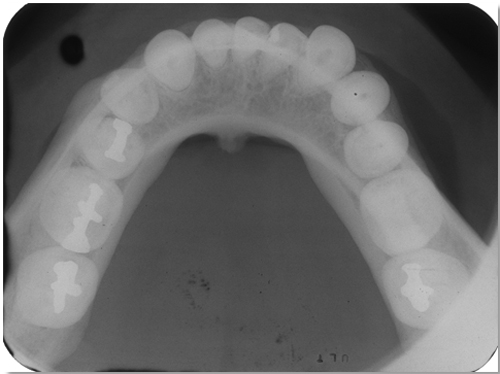 <ul><li><p>Largest intraoral film</p></li><li><p>4x size 2 </p></li><li><p>Used to examine the max and mand arch. </p></li></ul><p></p>