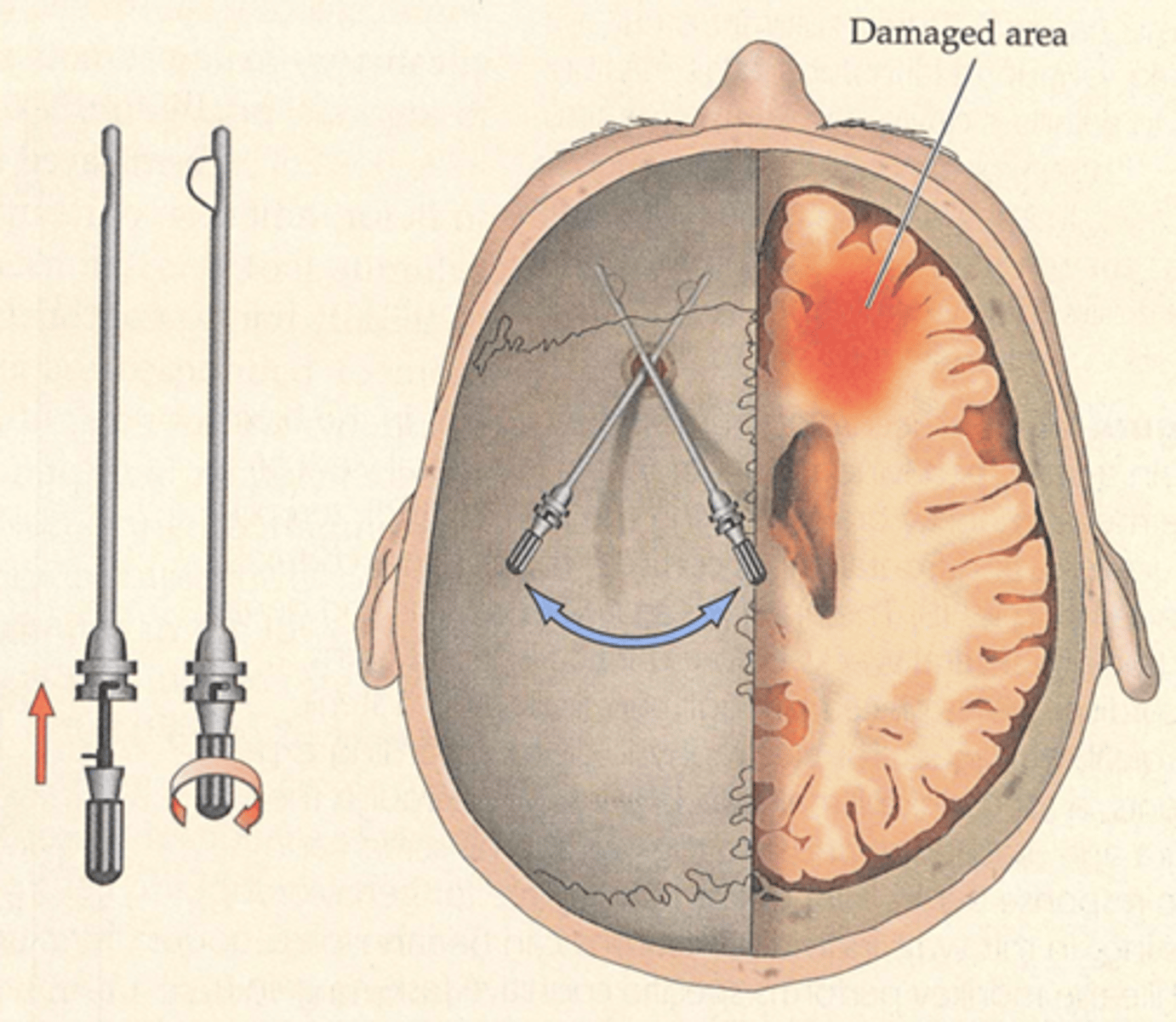<p>surgery that removes or destroys brain tissue in an effort to change behavior</p>