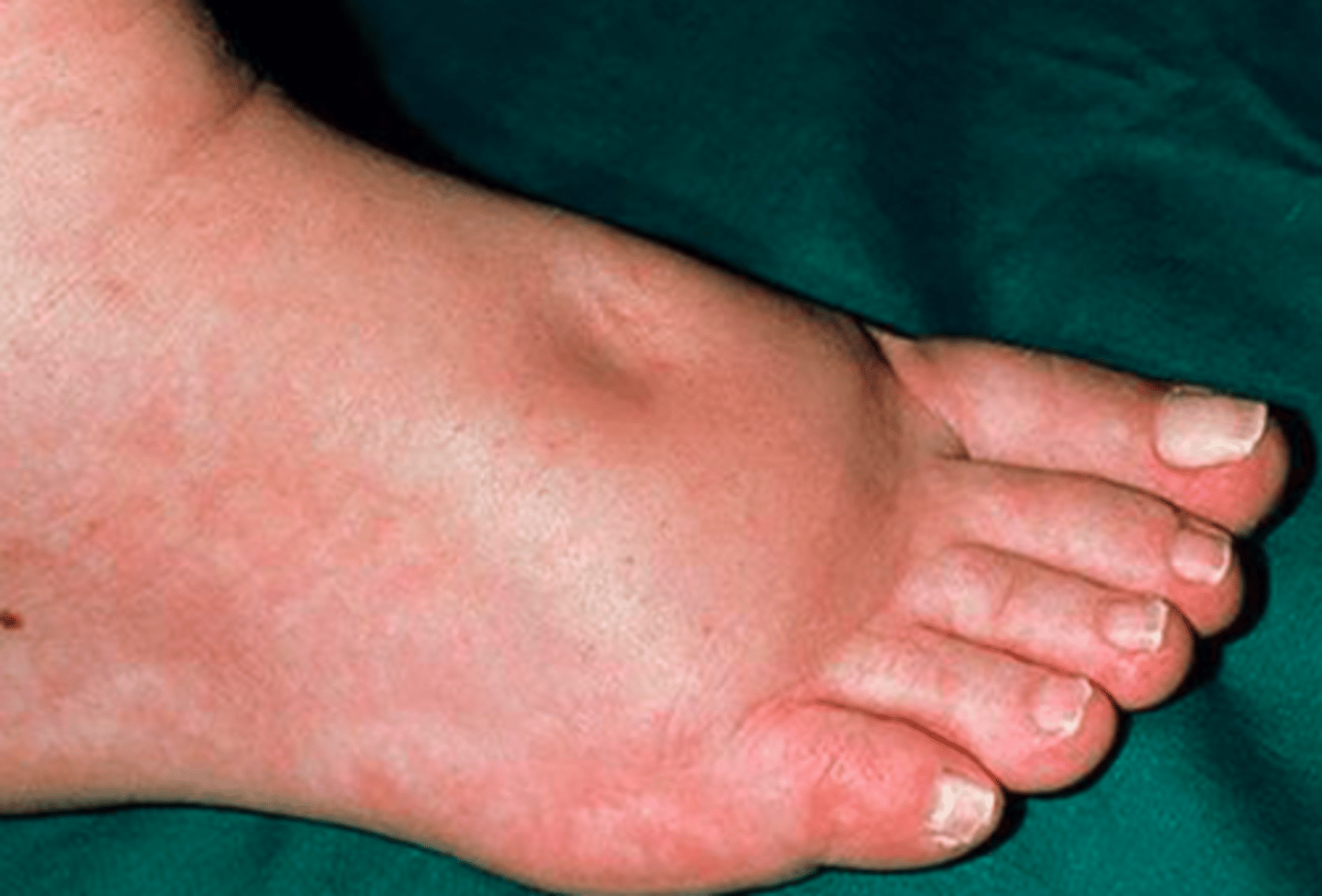 <p>swelling of the ankle</p>
