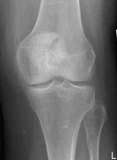 <p>What type of fracture is this?</p>