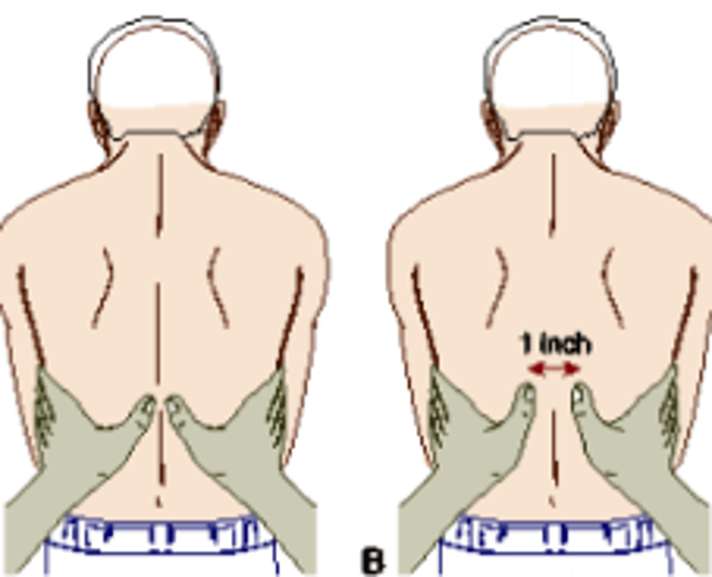 <p>Using the illustrated technique, the nurse is assessing for which finding in a patient with chronic obstructive pulmonary disease (COPD)?</p><p>a. Hyperresonance c. Reduced excursion</p><p>b. Tripod positioning d. Accessory muscle use</p>