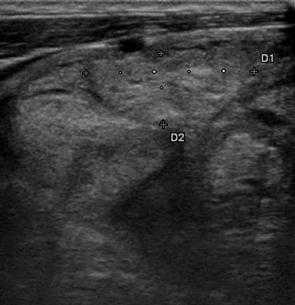 <p>What type of thyroid nodule is this - nodules may be solid or cystic; <strong>occasionally</strong> hyperfunctional</p>