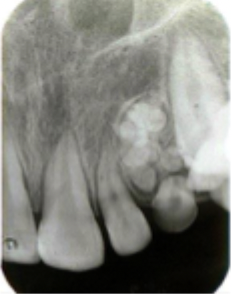 <p>What is this lesion? </p>