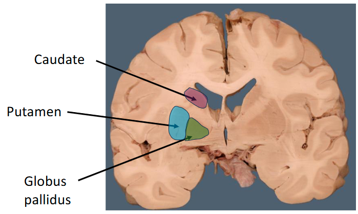 <p>Caudate and putamen (striatum)</p><ul><li><p>The caudate forms the sides of the lateral ventricle</p></li></ul><p></p>