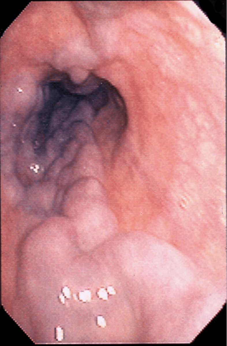 <p>- involves ruptures and bleeding of enlarged veins in the esophagus, causing significant blood loss and potential complications like shock and death.</p><p>- causes decreased bile → decreased absorption of fat-soluble vitamins (A, D, E, K) → decreased vit K = decreased clot factor production (2, 7, 9, 10) → increased bleeding risk d/t inability to clot</p><p>- also happens in the stomach (gastric) and rectum (hemorrhoids) </p>