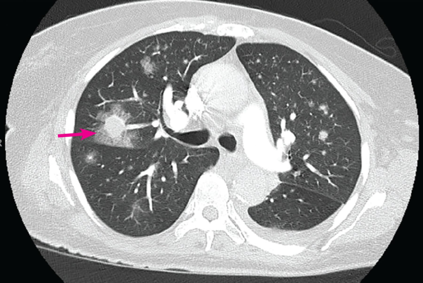 <p>Almost exclusively in<strong><em><mark data-color="yellow" style="background-color: yellow; color: inherit"> severely immunocompromised </mark></em></strong>patients, like in AIDs, organ transplant, BMT</p><p></p><p>GROWTH THROUGH <strong><em><mark data-color="red" style="background-color: red; color: inherit">BLOOD VESSELS</mark></em></strong> LEADING TO TISSUE INFARCT → contiguous spread (difficult to control)</p>