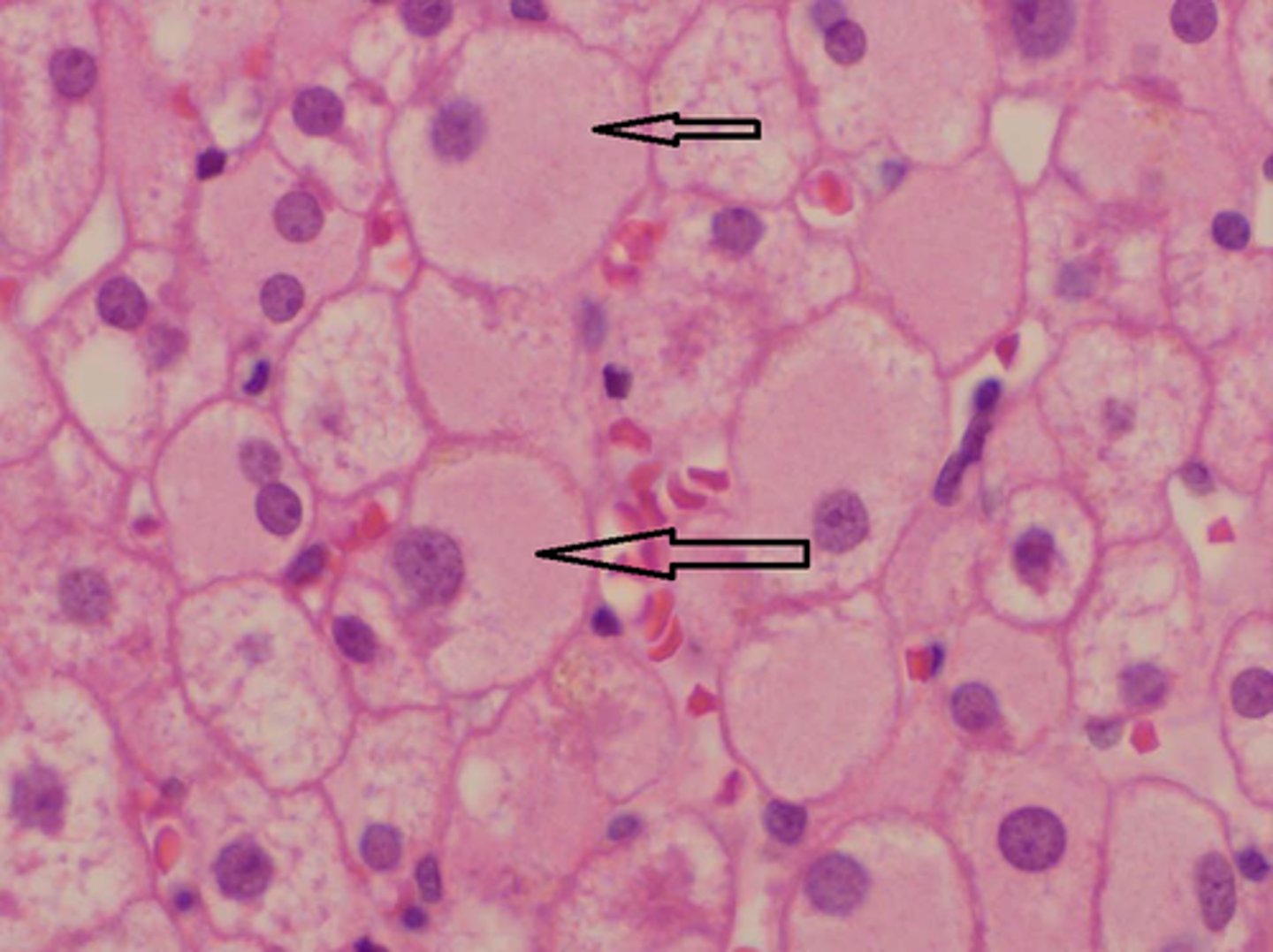 <p>What diagnosis is characterized by "ground glass" hepatocytes?</p>