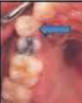 <p>tooth positioned toward the cheek</p>