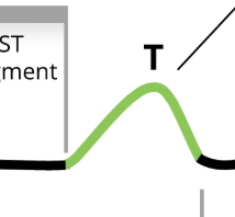 <p>Ventricular repolarization</p>