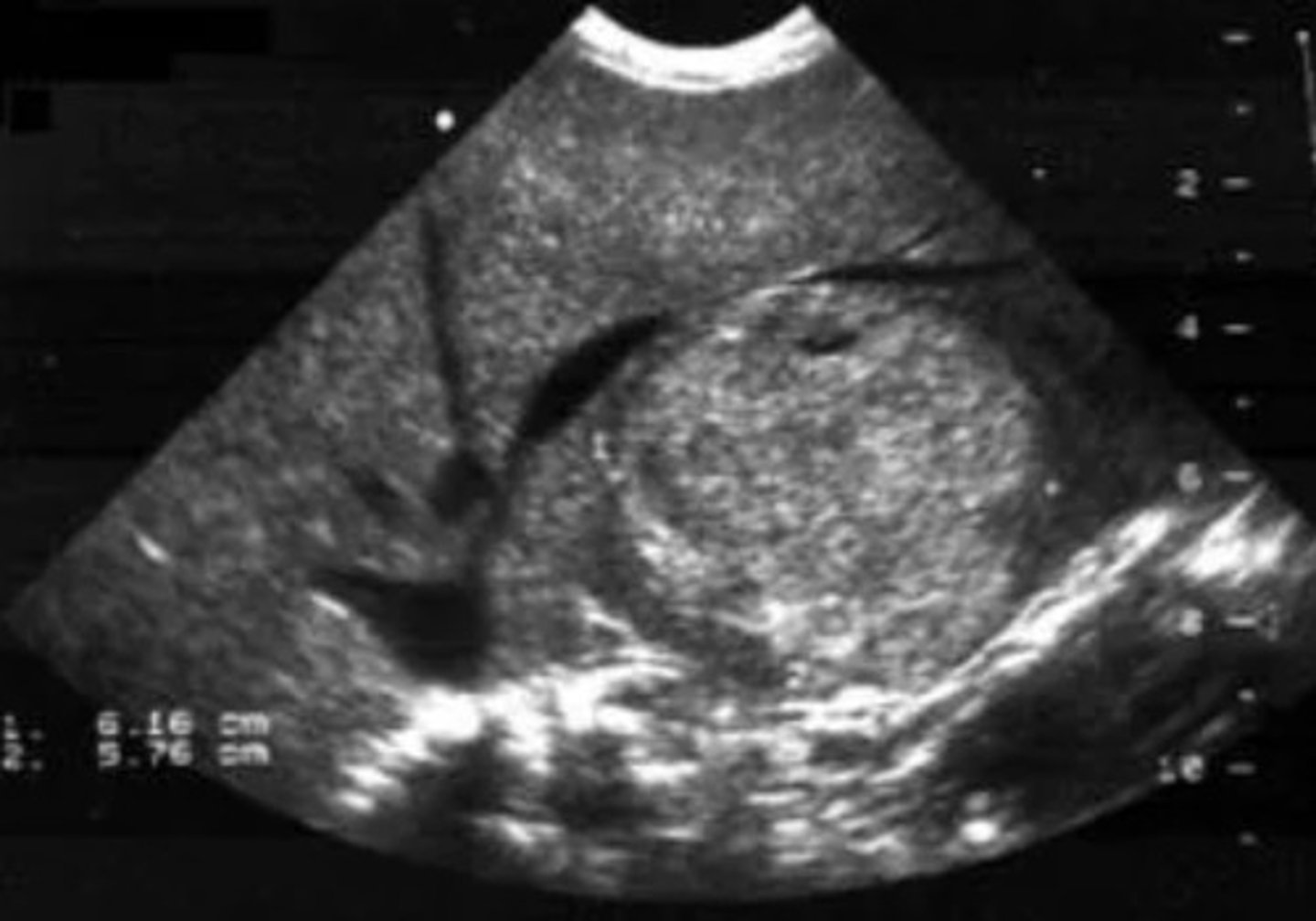 <p>Genetic disorder</p><p>Might see solid masses</p>