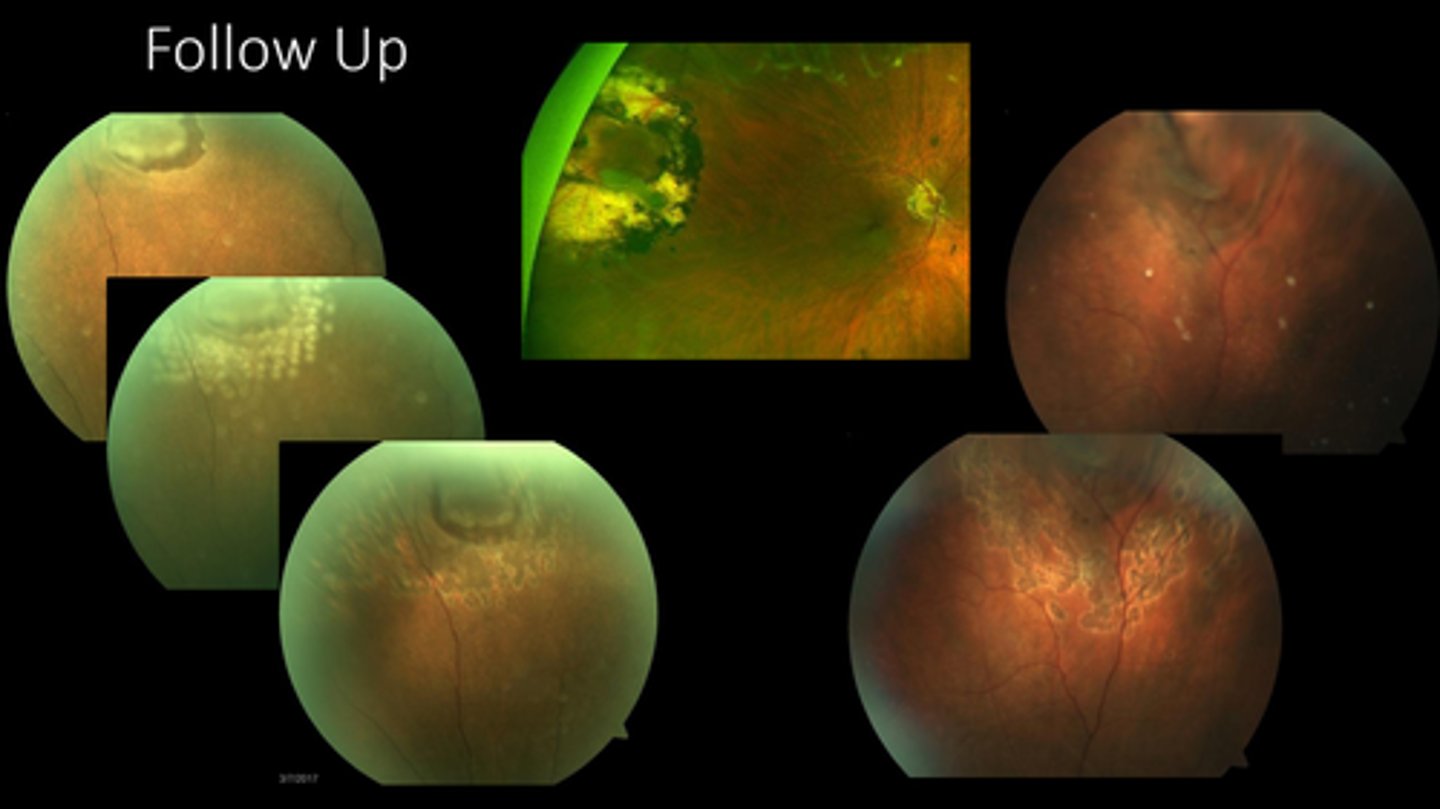 <p>What is the referral timeline for laser retinopexy?</p>