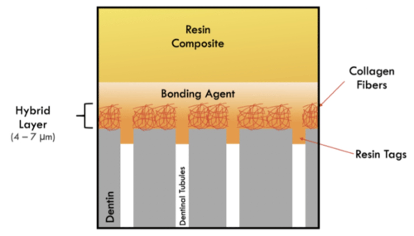 <p>• Removes the smear layer and opens the dentinal tubules</p><p>• Partially demineralizes the dentin, exposing collagen fibrils</p><p>• Increases surface energy and porosity, allowing adhesive infiltration</p><p>• Creates a substrate for micromechanical retention via formation of the hybrid layer</p><p>• Requires careful moisture control to maintain the ideal moist dentin state for bonding</p>