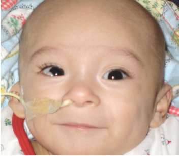 <p>what skeletal defect is shown in this image</p>