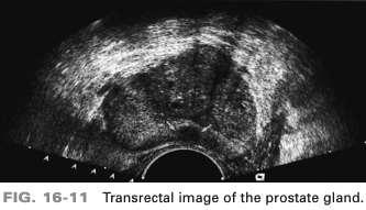 <p>patient presents with history of hematuria and elevated PSA. Neoplasm identified by arrows is in which region of prostate</p>