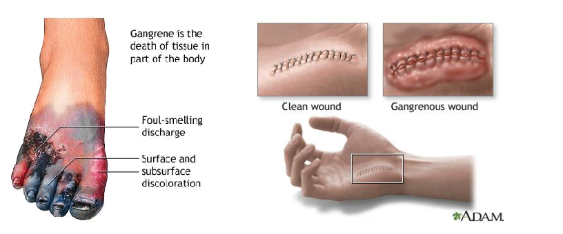<ul><li><p><span><span>за резервоар и източник на заразата се считат тревопасните животни</span></span><br><span><span>и човека, в червата на които газгангренните причинители са нормална микрофлора</span></span></p></li><li><p><span><span>там те не причиняват заболяване поради инактивиране</span></span><br><span><span>на екзотоксините им от чревните ензими</span></span></p></li><li><p><span><span>С изпражненията на</span></span><br><span><span>животните и човека вегетативните клетки попадат в почвата, където</span></span><br><span><span>спорулират и се съхраняват с години</span></span></p></li><li><p><span><span>Заразяването става най-често екзогенно през наранена кожа и лигавица</span></span></p></li><li><p><span><span>Инкубационен период -1-4 дни</span></span><br></p></li></ul><p></p>