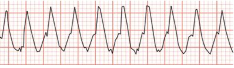 <p><span>A patient who has cardiomyopathy reports light-headedness during treatment. The physical therapist assistant observes the rhythm shown in the photograph. Which of the following responses is </span><strong>MOST</strong><span> appropriate for the assistant?</span></p>