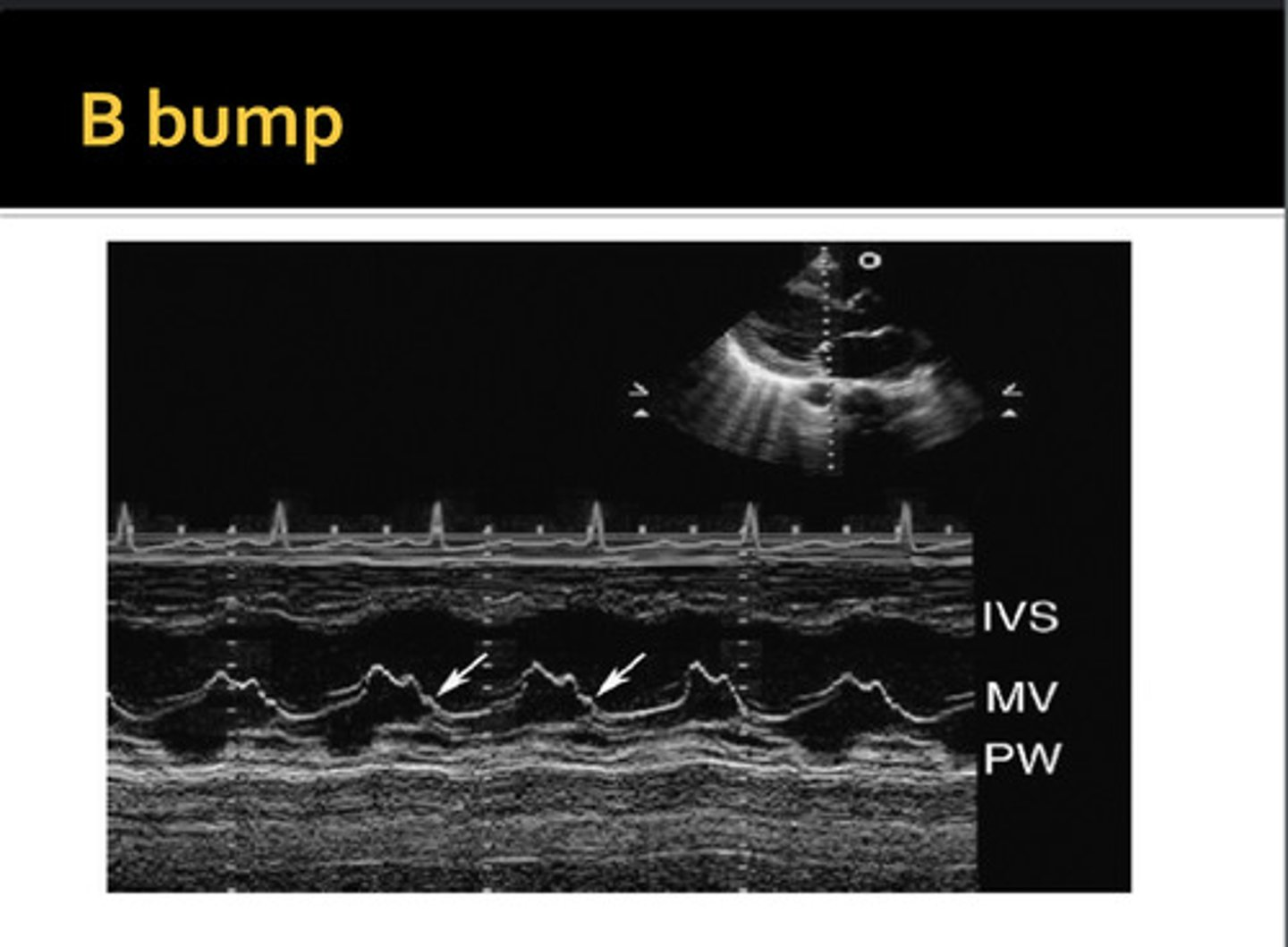 <p>extra hump between A-C; commonly seen with dilated cardiomyopathy and LV dilation; increased LVDP and LA pressure; decreased EF% and EPSS is >10mm</p>
