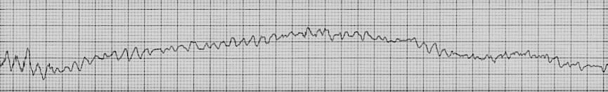 <p>WHAT IS THIS ECG READING? </p>